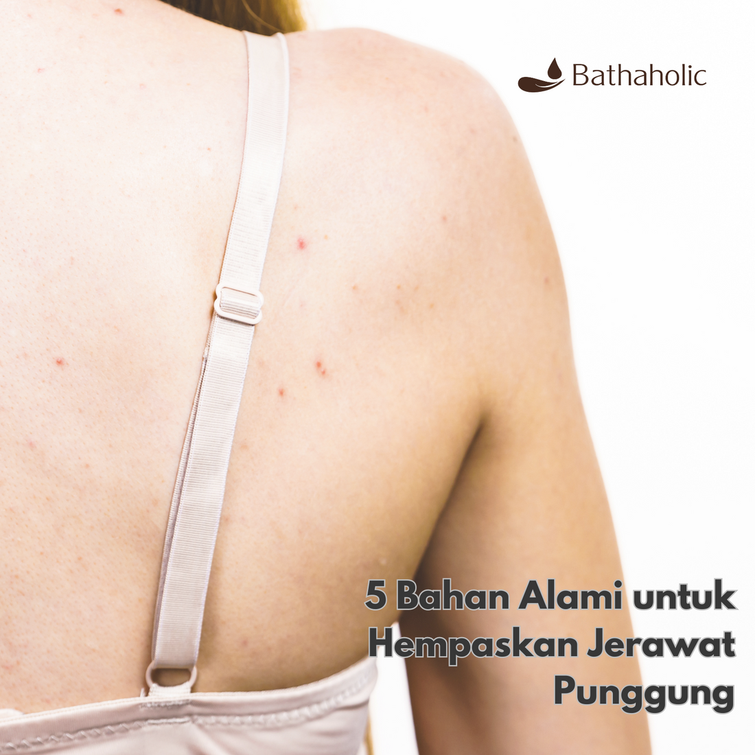 5 Bahan Alami untuk Hempaskan Jerawat Punggung